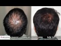 Hair Transplant Results, Hair Transplant Delhi