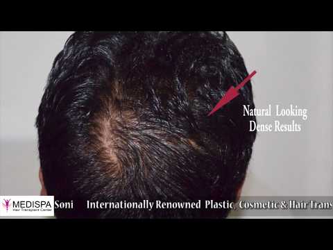 Hair Transplant Results, Hair Transplant Delhi