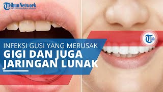 Periodontitis, Infeksi Gusi yang Bisa Merusak Gigi, Jaringan Lunak, dan Tulang Penyangga Gigi