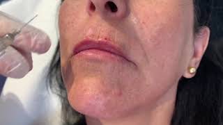 Tratamiento para el código de barras y perfil labial | Dermaforyou by Dra Carmen Galera