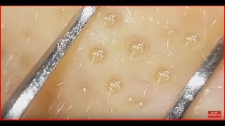How to clean in depth clogged pores with clip curved tweezers.