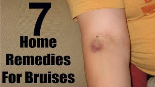 The Top 7 Home Remedies For Bruises - Get Rid Bruiese