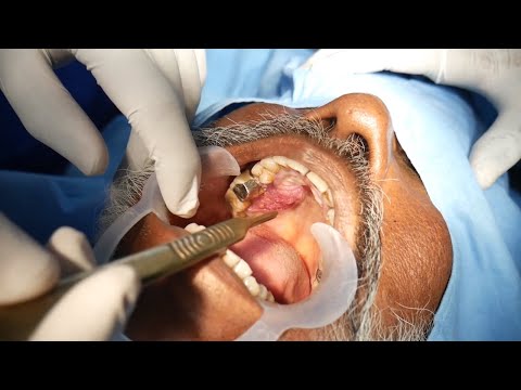 Incision Biopsy For Lesion Inside The Mouth