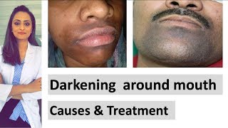 Darkening around mouth | causes | treatment | Dermatologist | Dr. Aanchal Panth