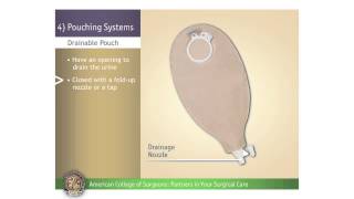 Pediatric Urostomy: Pouching Systems