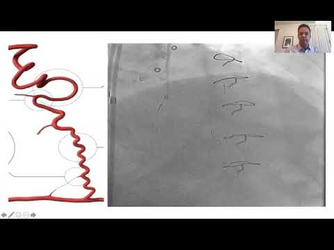New developments in retrograde CTO PCI_Nicholson_Coronary on Demand