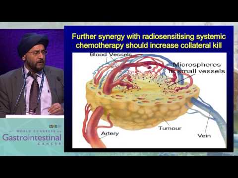 Tandem Talk: Liver directed therapy in incurable mCRC: When and how? - Radio- or chemoembolization