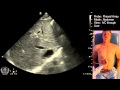 IVC Ultrasound STEP by STEP - Easiest Method