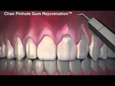 Chao Pinhole Gum Rejuvenation - Chao Pinhole Surgical Technique