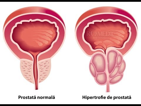 tratamentul supozitoarelor de prostatită cronică