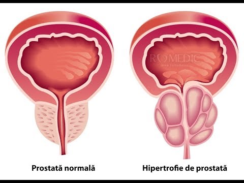 Prostatita acuta si cronica: simptome, cauze si tratament - Medicamente si ingrijire