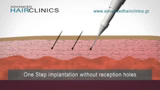 One Step Hair Implantation method: Advanced FUE (video)