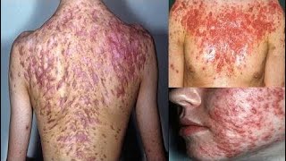 how to get rid of body acne in 2 days | how to get rid of body acne-Healthy Wealthy