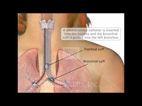 Double-Lumen Catheter Intubation - Medical Animation