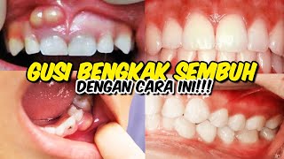 Download lagu 5 HEALTH INFORMATION ON EFFECTIVE WAYS TO TREAT SWELLING GUMS NATURALLY mp3 Download lagu 5 HEALTH INFORMATION ON EFFECTIVE WAYS TO TREAT SWELLING GUMS NATURALLY mp3
