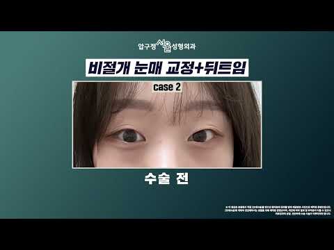 수술 전후 180도 달라진 눈매💫 사례 2가지 공개