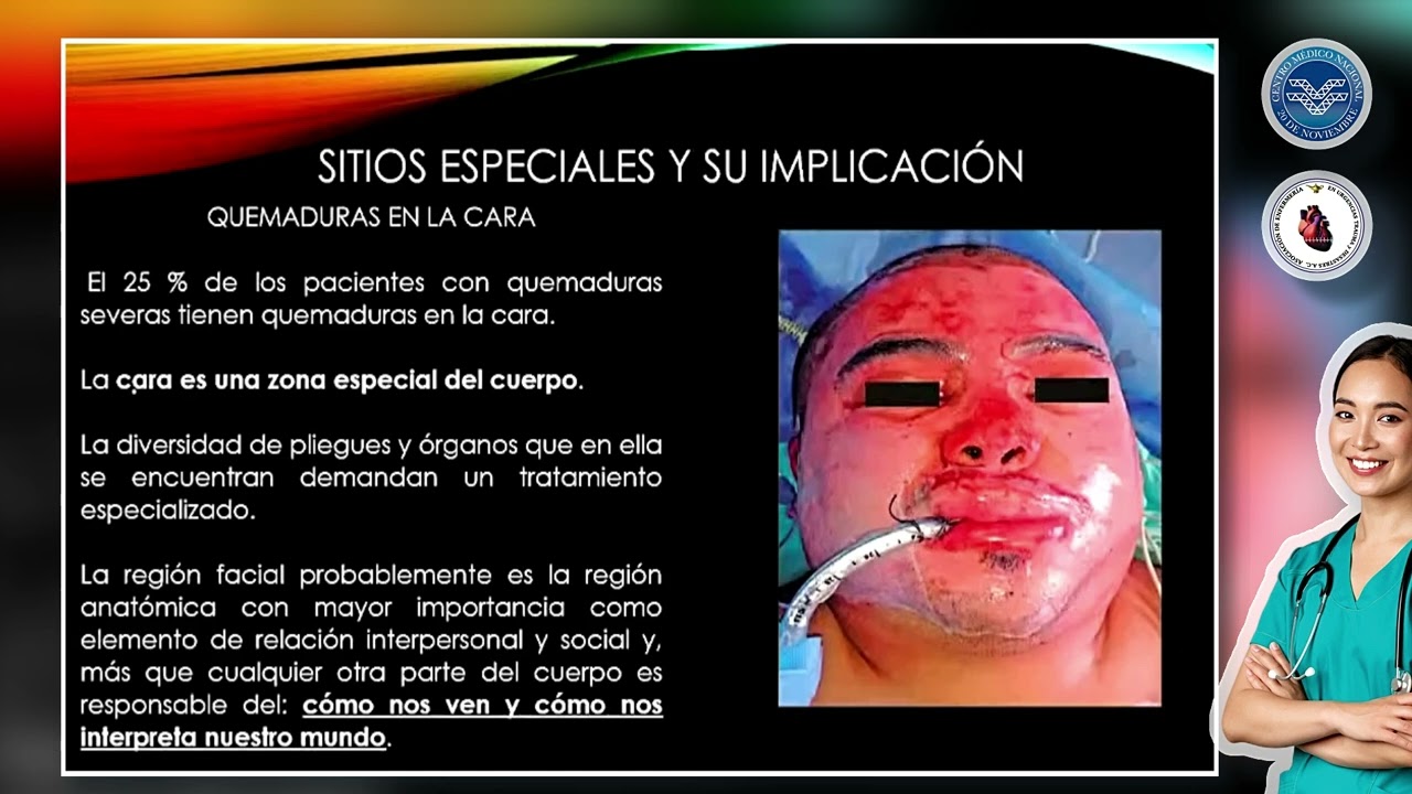 Manejo de Quemaduras