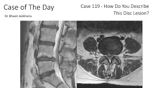 Case of the Day - 119 - 2025 10 15 - How Do You Describe This Disc Lesion?