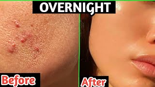 How To Remove Pimples Overnight | Acne Treatment | Get Glowing skin