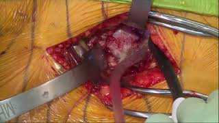 DASH Live 4 - Navigated Primary Hip Replacement through a Direct Anterior Approach