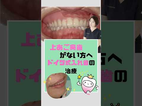 上あご奥歯がない方へ〜ドイツ式入れ歯で治療〜