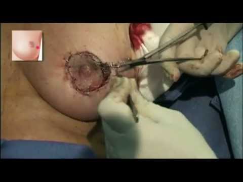comment traiter un ptosis