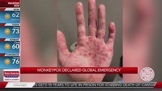 Bay Area man shares story of monkeypox recovery