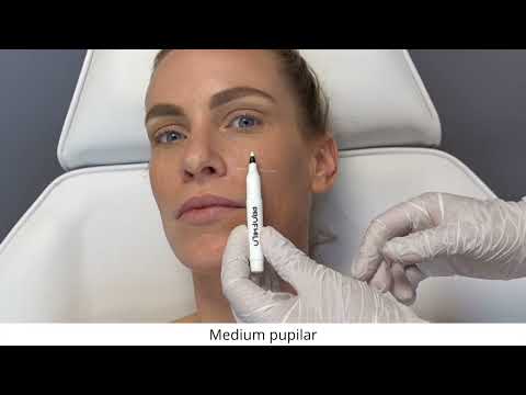 Profhilo Bio Aesthetic Points (BAP) Technique explained by Dr. Gabriel Siquier