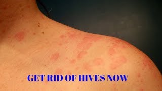 how to get rid of hives on your body