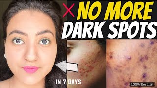 In 7 DAYS : Remove DARK SPOTS, ACNE SCARS, PIMPLE MARKS & PIGMENTATION in JUST 7 DAYS | 100% RESULTS