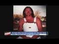 Colo Man With Flesh Eating Bacteria Has Long Road Ahead