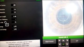 ICRS Femtotunnel Creation after Docking