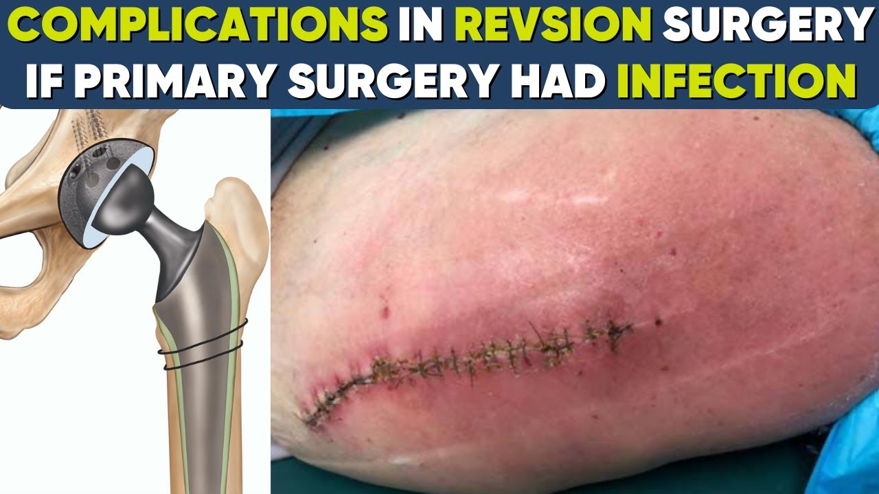 Can I have a Revision Surgery if I had an INFECTION in the Primary or first Hip Replacement Surgery?
