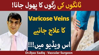 Download lagu Varicose Veins Kya hai? | Tango ki Nas ka Phul Jana | Causes and Treatment of Varicose Veins mp3