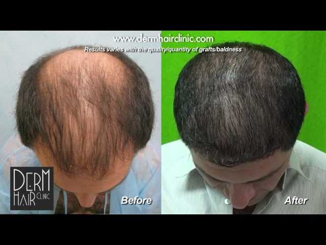 Hair Transplant Shaved Head 51