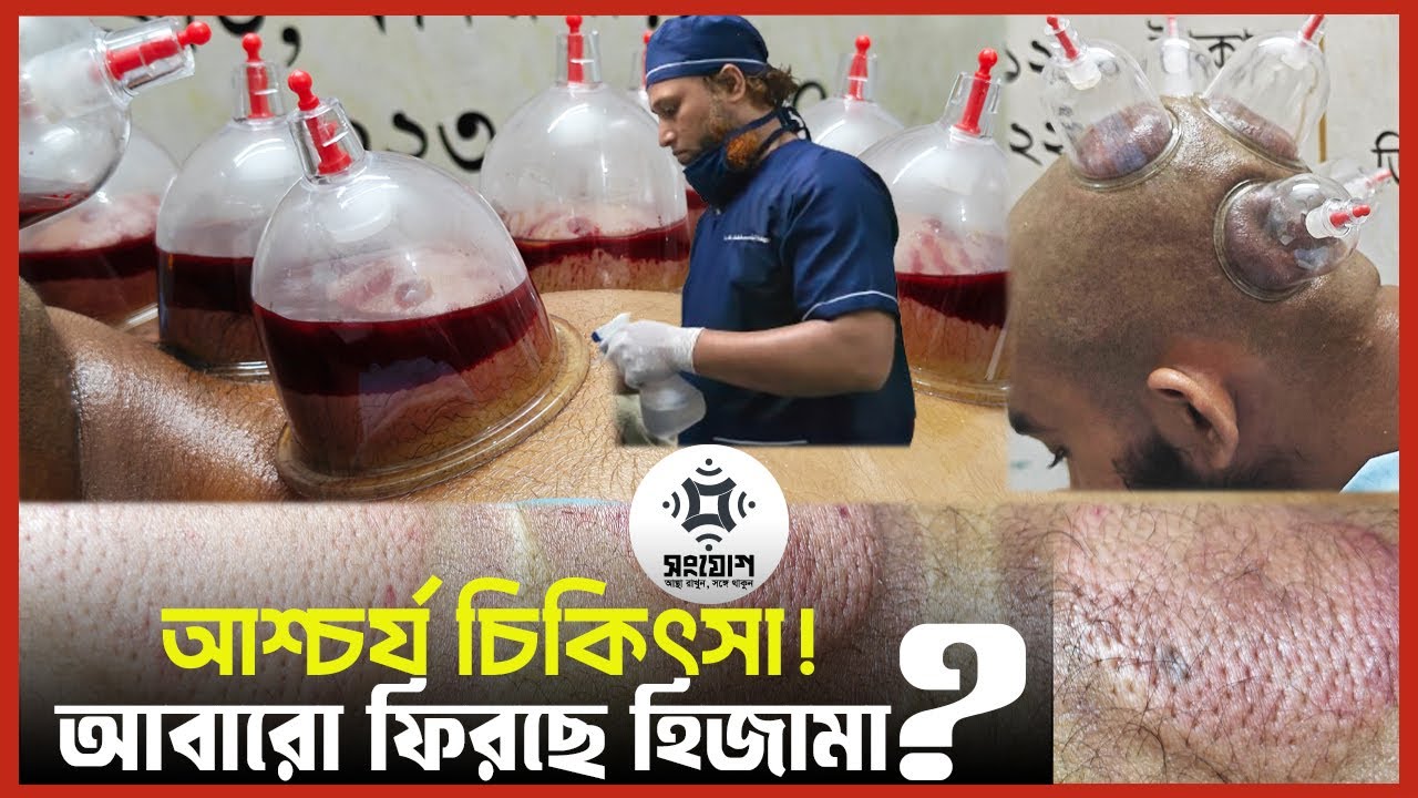 আবারো কি ফিরে আসছে আশ্চর্য চিকিৎসা হিজামা