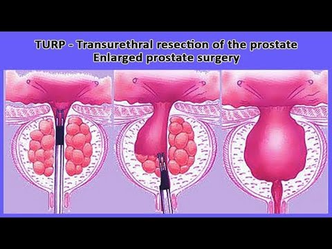 milyen antibiotikumot tesz a prosztatitishez)