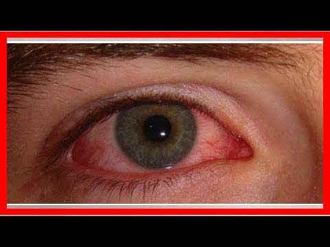 Gerötete Augen – Ursachen und einfache Hausmittel