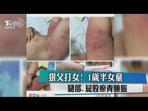 打屁股瘀青