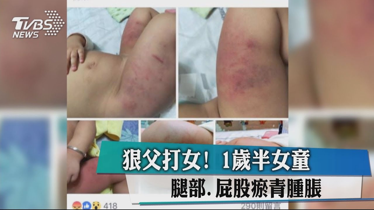 狠父打女! 1歲半女童腿部、屁股瘀青腫脹