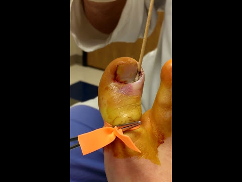 Ingrown toenail removal