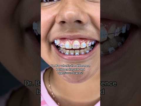 Regular Braces vs LightForce Braces: What's the Difference?