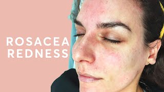 How to treat a red face? - Rosacea treatment