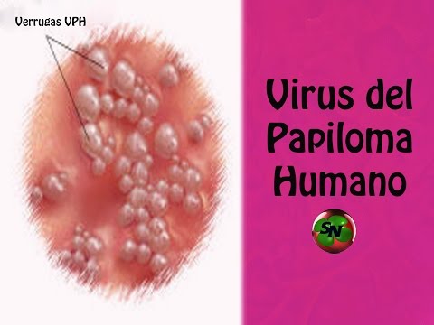 Virus del papiloma humano - VPH - ¿Qué es? - Síntomas de Papiloma humano