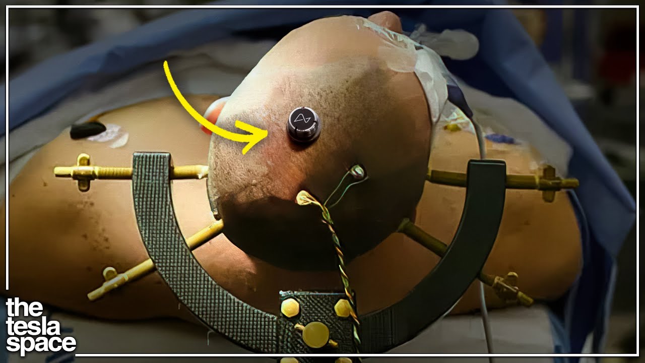 Neuralink Reveals First Human Patient!