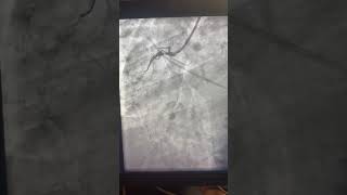 Download lagu One Case, Full Technique: Complete CTO RCA Recanalization. Step-by-Step! mp3 Download lagu One Case, Full Technique: Complete CTO RCA Recanalization. Step-by-Step! mp3