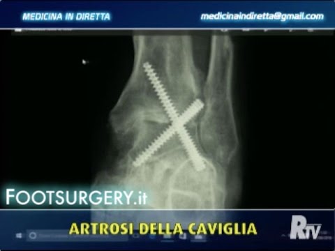 Procedura di scaricamento del ginocchio Il valore della protesi dellarticolazione dellanca a Belgorod