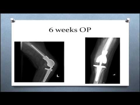 Periprosthetic femur fracture management: Panel discussion
