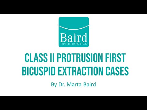 Treatment of Class II with Protrusion: First Bicuspid Extractions with Braces and Invisalign
