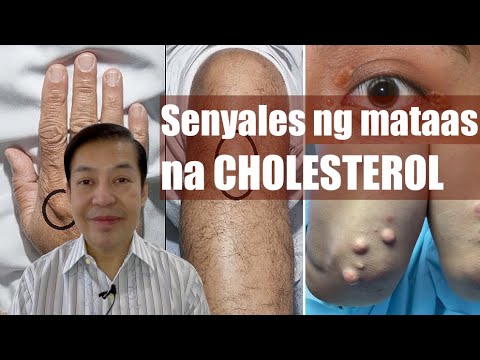 Mga senyales na mataas ang cholesterol